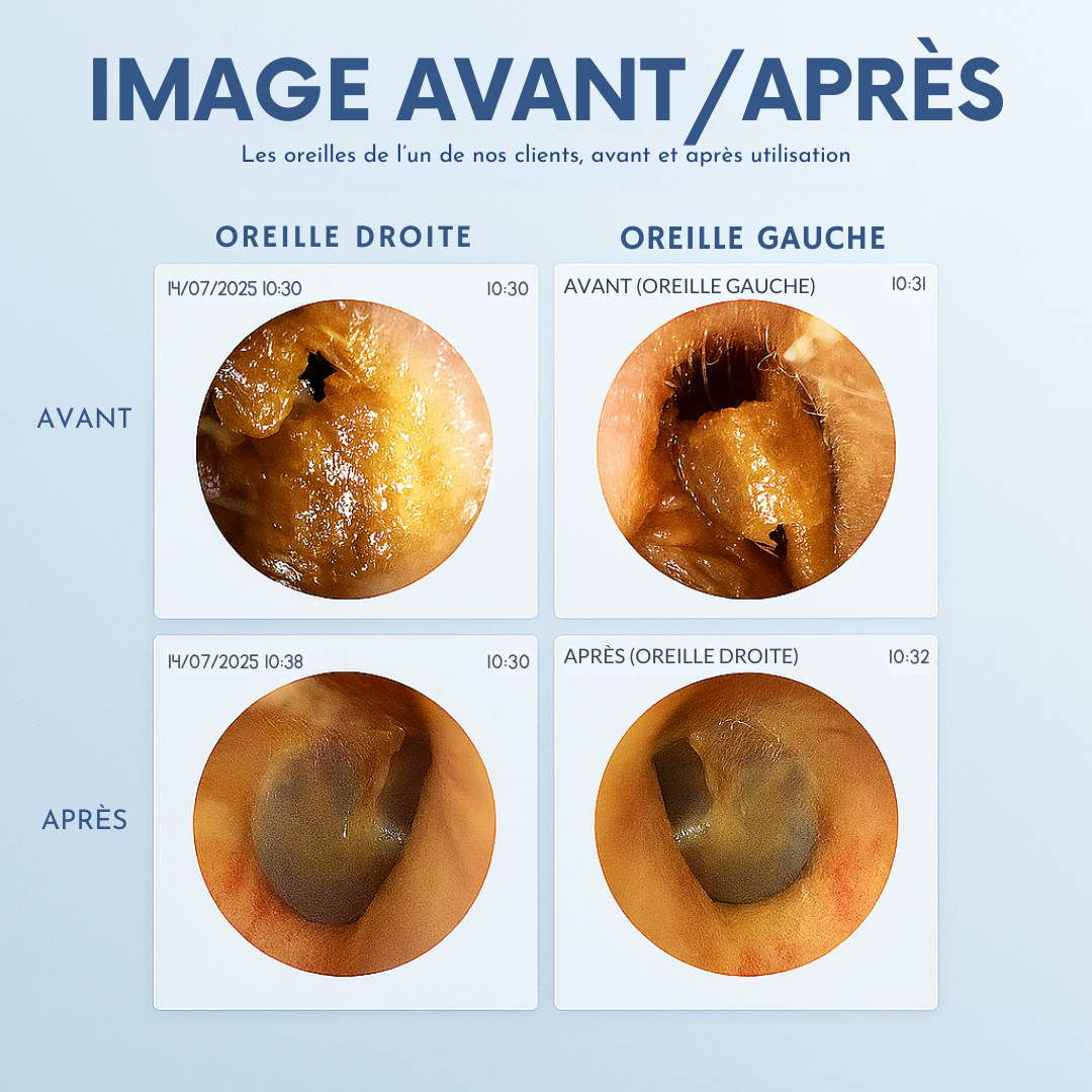 WaxClean™ – Nettoyeur d’oreilles intelligent avec technologie avancée