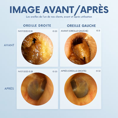 WaxClean™ – Nettoyeur d’oreilles intelligent avec technologie avancée