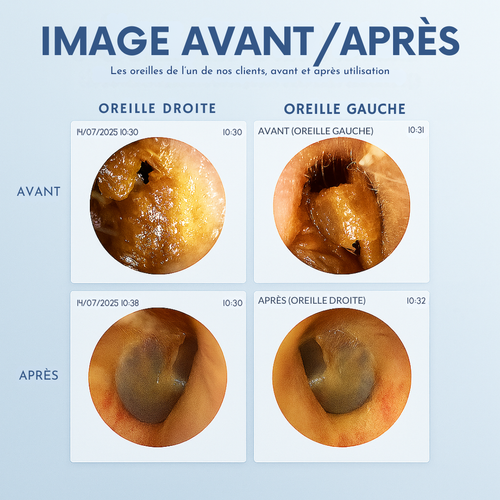 WaxClean™ – Nettoyeur d’oreilles intelligent avec technologie avancée