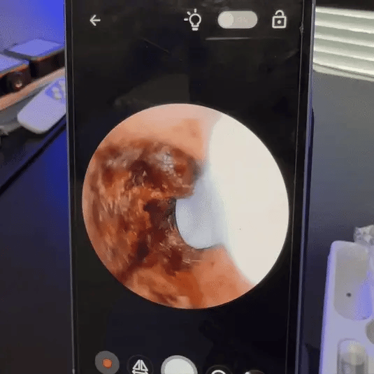 20 Ans D’accumulation De Cérumen